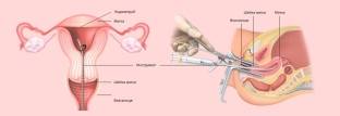 Paypel-biopsiya-endometriya.jpg
